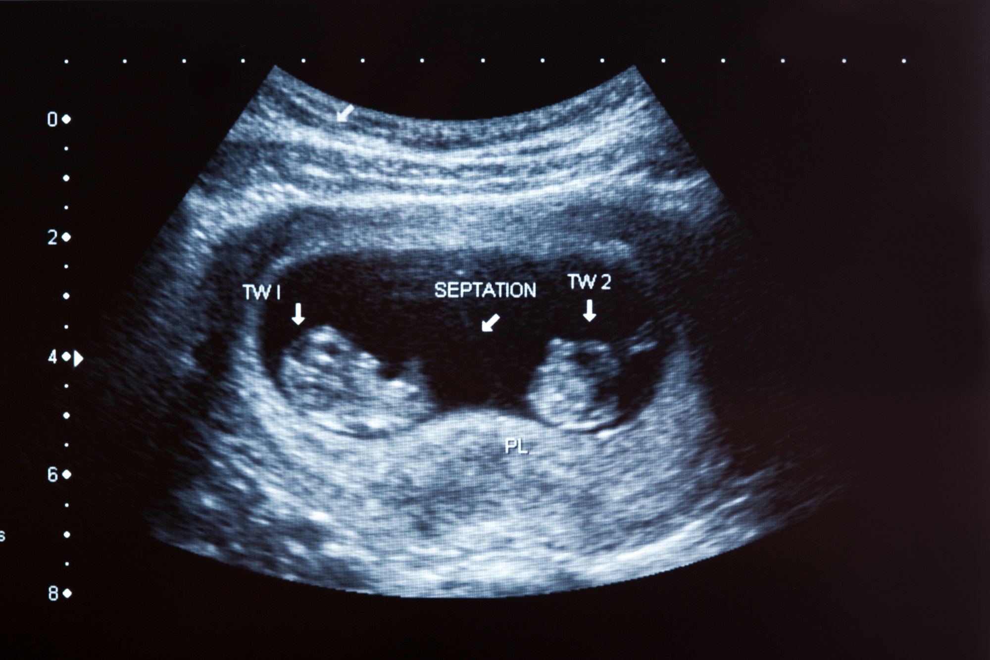 Ultrasound scan of 10 months old twins